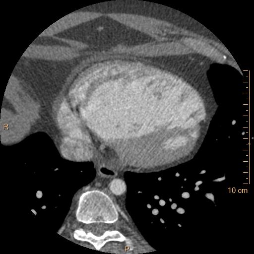 Atrial septal defect (upper sinus venosus type) with partial anomalous pulmonary venous return into superior vena cava (Radiopaedia 73228-83961 A 215).jpg