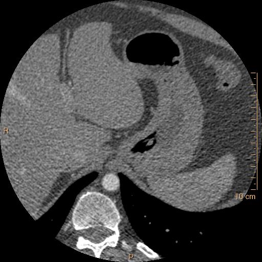 Atrial septal defect (upper sinus venosus type) with partial anomalous pulmonary venous return into superior vena cava (Radiopaedia 73228-83961 A 303).jpg