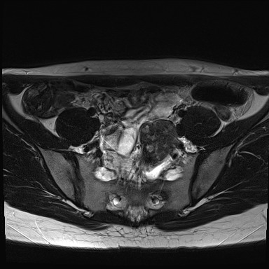 File:Atypical deep infiltrating endometriosis (Radiopaedia 44470-48125 Axial T2 5).jpg