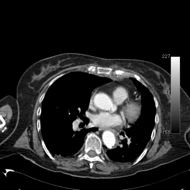 Atypical dissection of the thoracic aorta (Radiopaedia 10975-11393 A 42).jpg
