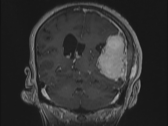Atypical meningioma (Radiopaedia 62985-71406 Coronal T1 C+ 80).jpg
