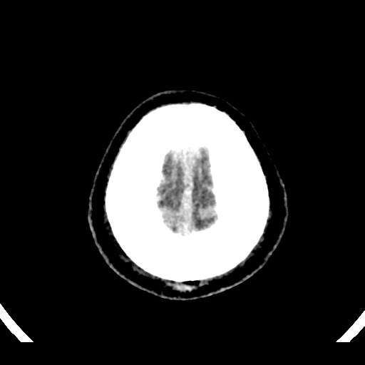 File:Atypical meningioma (WHO grade II) with brain invasion (Radiopaedia 57767-64728 Axial non-contrast 44).png