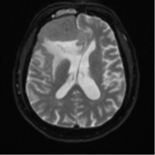 File:Atypical meningioma (WHO grade II) with brain invasion (Radiopaedia 57767-64729 Axial DWI 17).png