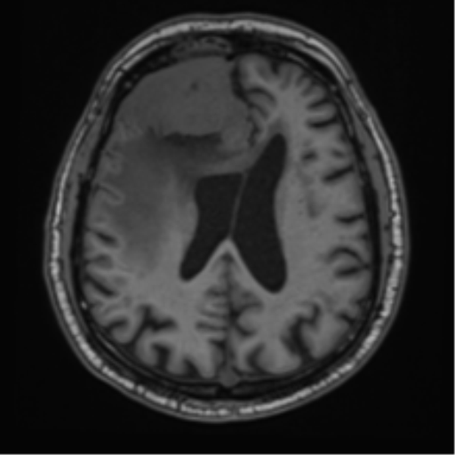 File:Atypical meningioma (WHO grade II) with brain invasion (Radiopaedia 57767-64729 Axial T1 32).png