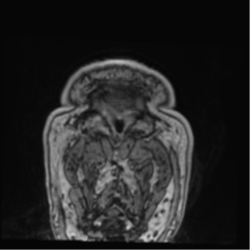File:Atypical meningioma (WHO grade II) with brain invasion (Radiopaedia 57767-64729 Coronal T1 C+ 87).png