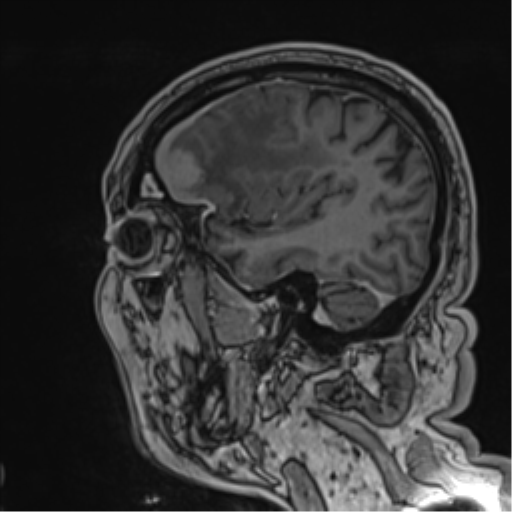 File:Atypical meningioma (WHO grade II) with brain invasion (Radiopaedia 57767-64729 Sagittal T1 C+ 50).png