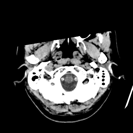 File:Atypical meningioma (WHO grade II) with osseous invasion (Radiopaedia 53654-59715 Axial non-contrast 7).png