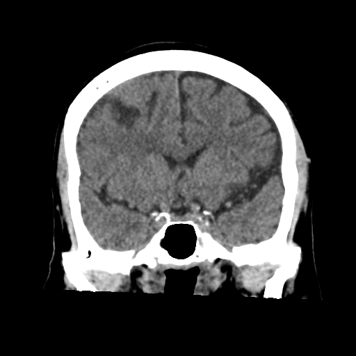 Atypical meningioma (WHO grade II) with osseous invasion (Radiopaedia 53654-59715 Coronal non-contrast 27).png