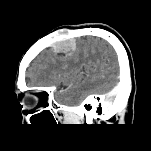 File:Atypical meningioma (WHO grade II) with osseous invasion (Radiopaedia 53654-59715 G 14).png