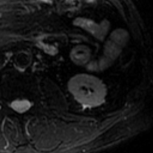 File:Atypical renal cyst on MRI (Radiopaedia 17349-17046 Axial T2 fat sat 18).jpg