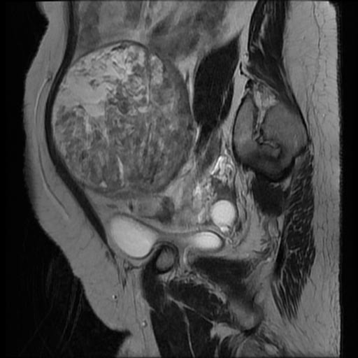 File:Atypical retroperitoneal lymphocoeles with large leiomyoma of uterus (Radiopaedia 32084-33027 Sagittal T2 24).jpg