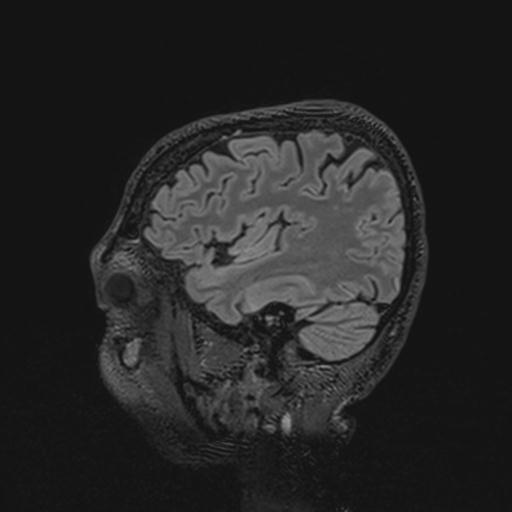 Autoimmune limbic encephalitis (Radiopaedia 30363-31005 Sagittal FLAIR 119).jpg