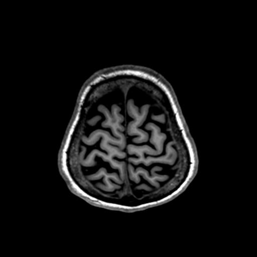 Autoimmune limbic encephalitis (Radiopaedia 30363-31005 T1 Axial 1mm 132).jpg