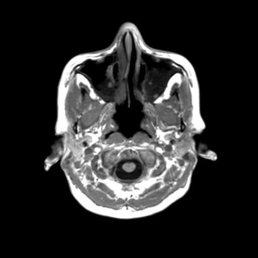 Autoimmune limbic encephalitis (Radiopaedia 30363-31005 T1 Axial 3mm 5).jpg