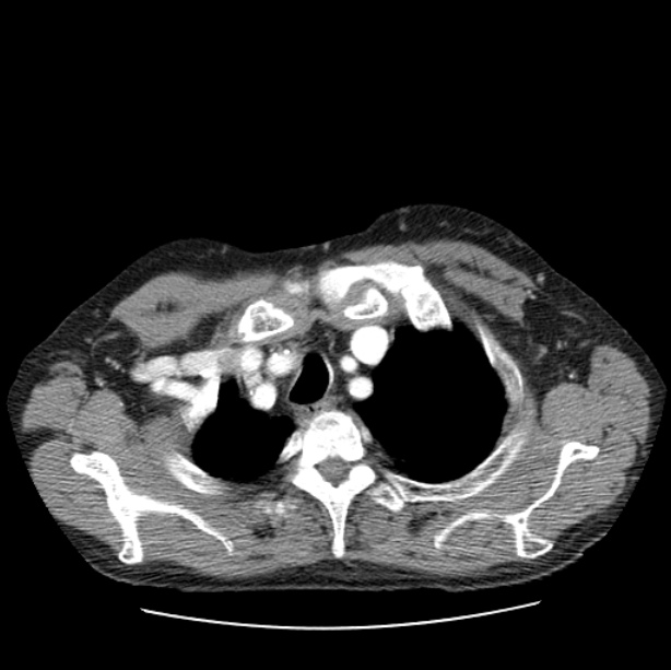 Autosomal dominant polycystic kidney disease (Radiopaedia 27851-28094 B 9).jpg