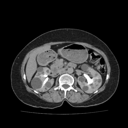 Autosomal dominant polycystic kidney disease (Radiopaedia 38189-40194 Axial C+ delayed 18).jpg