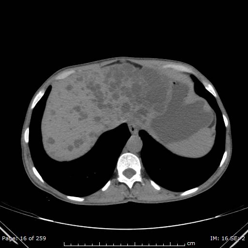 File:Autosomal dominant polycystic kidney disease (Radiopaedia 44122-47684 Axial 83).jpg