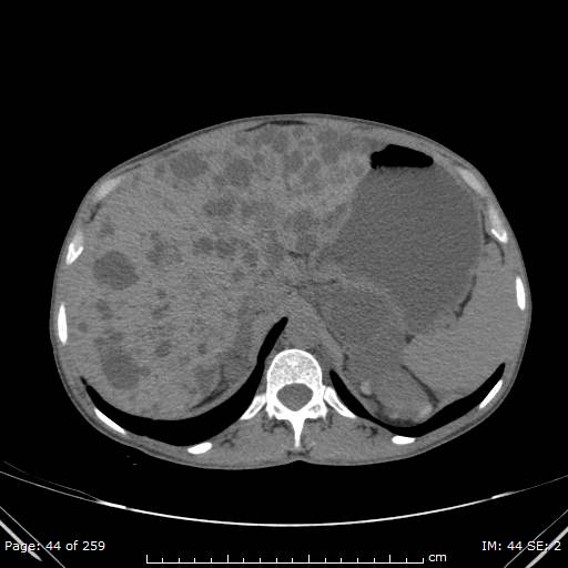 File:Autosomal dominant polycystic kidney disease (Radiopaedia 44122-47684 Axial non-contrast 16).jpg