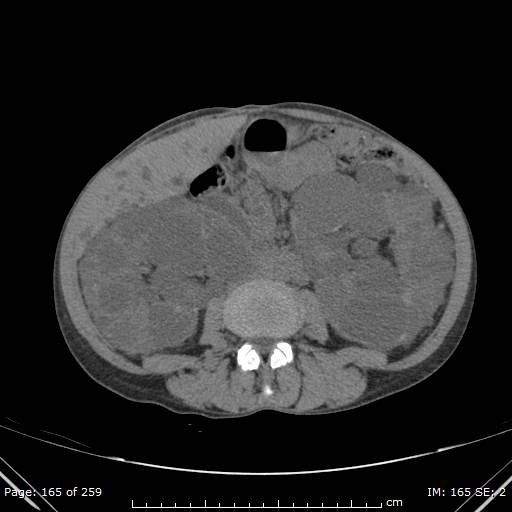 Autosomal dominant polycystic kidney disease (Radiopaedia 44122-47684 Axial non-contrast 59).jpg