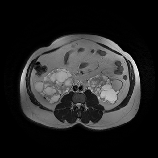 File:Autosomal dominant polycystic kidney disease (Radiopaedia 50259-55611 Axial T2 28).jpg
