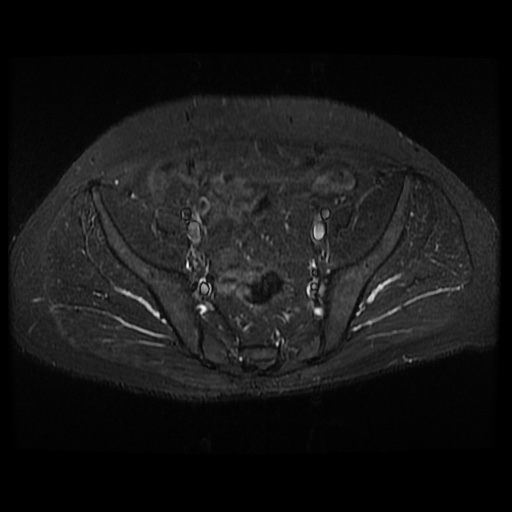 File:Avascular necrosis of the hip (Radiopaedia 61503-69465 Axial STIR 7).jpg