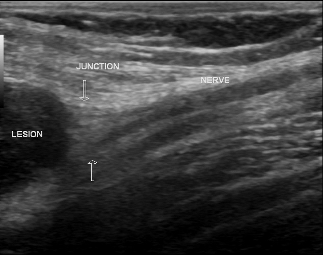 File:Axillary nerve sheath tumor (Radiopaedia 12201-12526 E 1).jpg