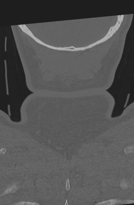 Axis peg fracture (type 3) and atlas lateral mass (type 4) fracture (Radiopaedia 37474-39324 Coronal bone window 66).png