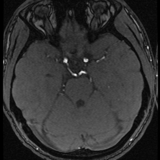 Azygos anterior cerebral artery (Radiopaedia 17059-16756 Axial MRA 49).jpg