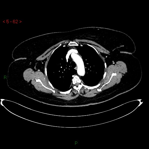 Azygos fissure and lobe (Radiopaedia 47620-52278 A 48).jpg