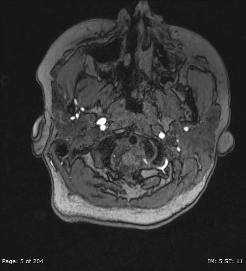 Balo concentric sclerosis (Radiopaedia 61637-69636 Axial MRA 5).jpg