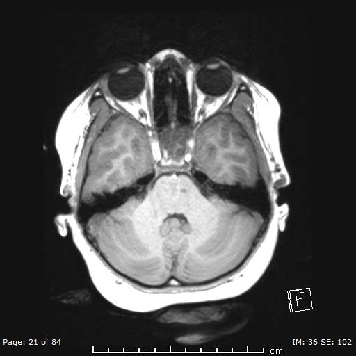 File:Balo concentric sclerosis (Radiopaedia 61637-69636 Axial T1 21).jpg