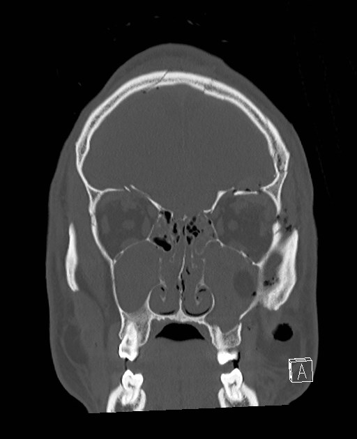 Base of skull fracture with bilateral Le Fort fractures (Radiopaedia 47094-51638 Coronal bone window 74).jpg
