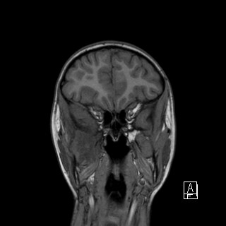 Base of skull rhabdomyosarcoma (Radiopaedia 32196-33142 Coronal T1 10).jpg