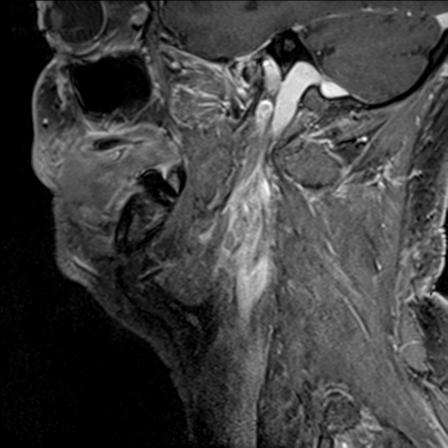 Base of tongue squamous cell carcinoma (Radiopaedia 31174-31884 F 129).jpg