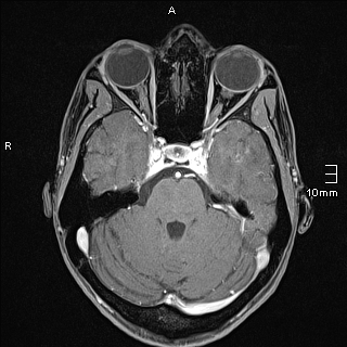 Basilar artery perforator aneurysm (Radiopaedia 82455-99523 G 41).jpg