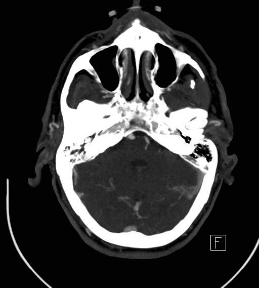 File:Basilar artery thrombosis (Radiopaedia 26986-27163 A 27).jpg