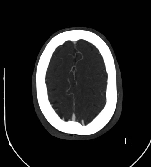 File:Basilar artery thrombosis (Radiopaedia 26986-27163 A 70).jpg