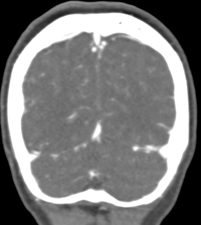 File:Basilar tip aneurysm with coiling (Radiopaedia 53912-60086 B 134).jpg