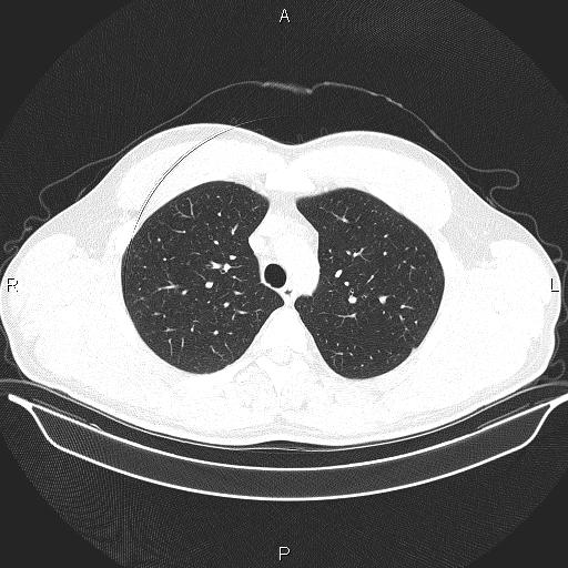 Beam hardening and ring artifacts (Radiopaedia 85323-100915 Axial lung window 24).jpg