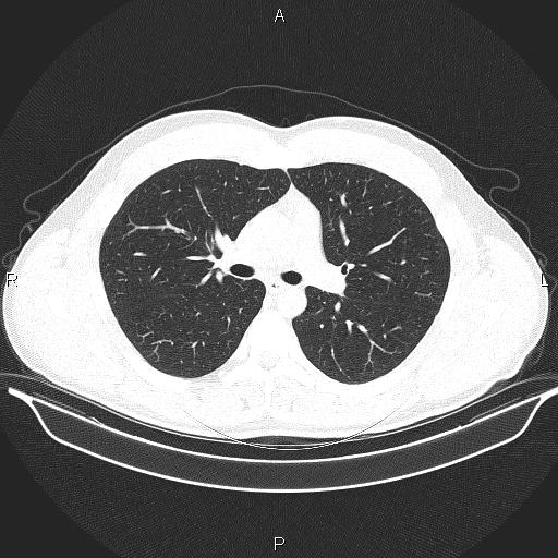 Beam hardening and ring artifacts (Radiopaedia 85323-100915 Axial lung window 33).jpg