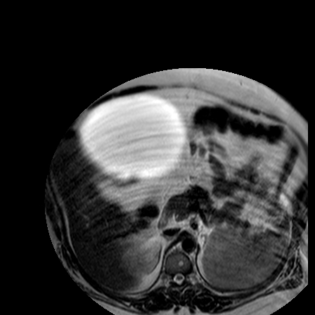 File:Benign seromucinous cystadenoma of the ovary (Radiopaedia 71065-81300 B 35).jpg