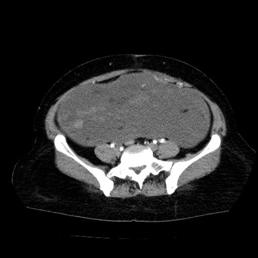 Benign spindle cell tumor - abdominopelvic (Radiopaedia 61300-69212 A 44).jpg