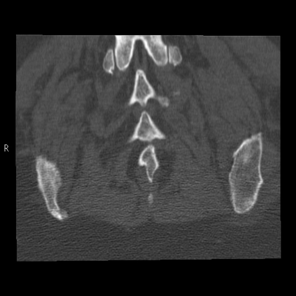 Bertolotti syndrome (Radiopaedia 24864-25128 Coronal bone window 43).jpg