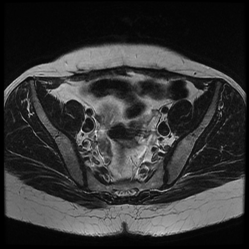 File:Bicornuate uterus (Radiopaedia 51676-57472 Axial T2 23).jpg