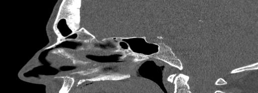 Bilateral Ectopic Infraorbital Nerves (Radiopaedia 49006-54084 Sagittal bone window 26).jpg