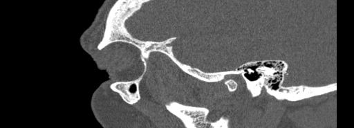 Bilateral Ectopic Infraorbital Nerves (Radiopaedia 49006-54084 Sagittal bone window 52).jpg