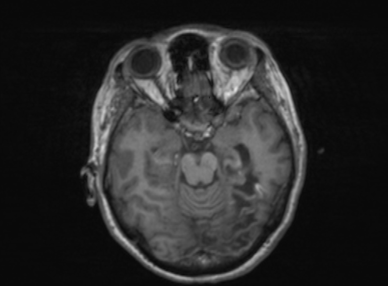 Bilateral PCA territory infarction - different ages (Radiopaedia 46200-51784 Axial T1 273).jpg