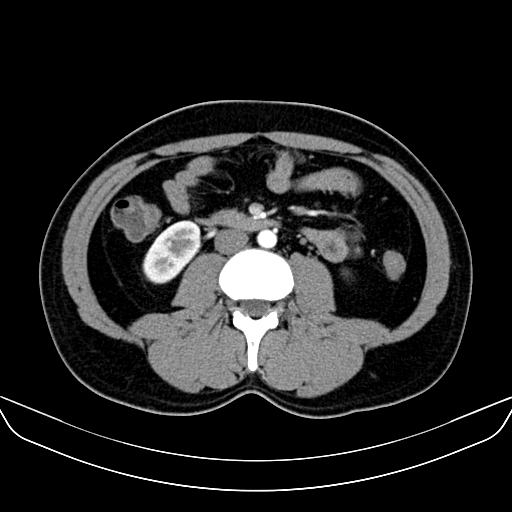 File:Bilateral accessory renal arteries with mild pelvi-ureteric junction (PUJ) obstruction (Radiopaedia 66357-75596 A 32).jpg