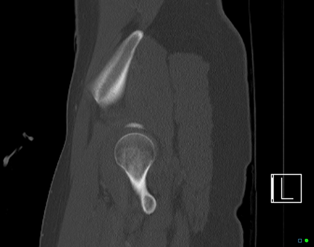 Bilateral acetabular fractures (Radiopaedia 79272-92308 Sagittal bone window 14).jpg