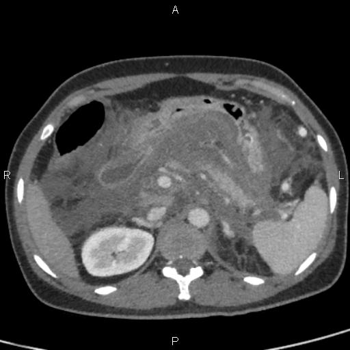 Bilateral adrenal gland hyperenhancement in pancreatitis (Radiopaedia 86642-102753 E 30).jpg